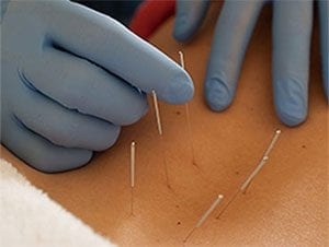 Dry Needling