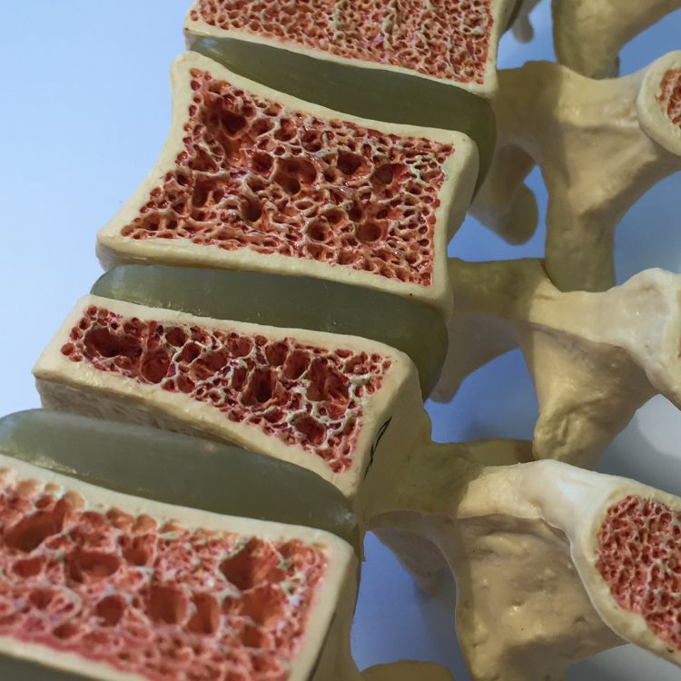 cross-section-osteoporosis-750×750 osteoporosis